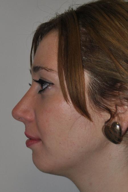 After image 4 Case #122736 - Hybrid Rhinoplasty
