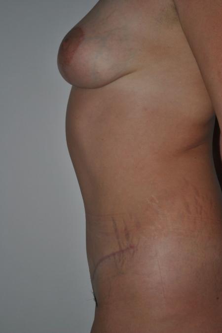 After image 4 Case #122776 - Breast Autoaugmentation And Abdominoplasty