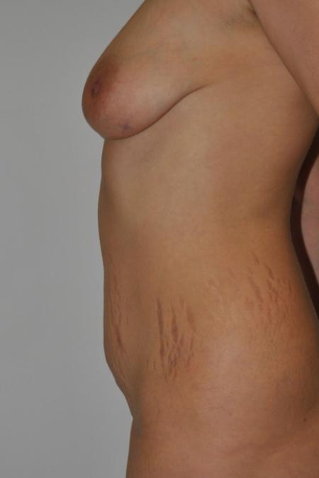 Before image 4 Case #122776 - Breast Autoaugmentation And Abdominoplasty