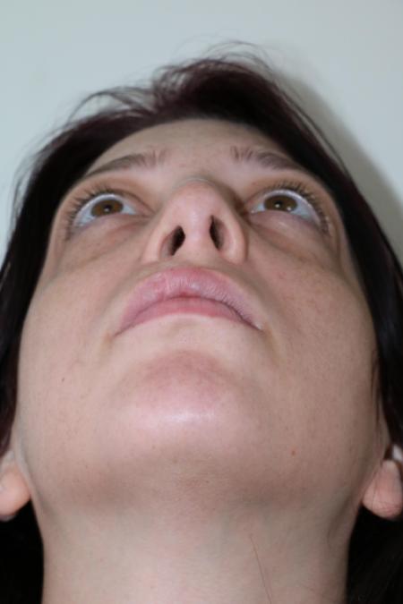 After image 6 Case #123116 - Late Cleft Lip Nasal Deformity 