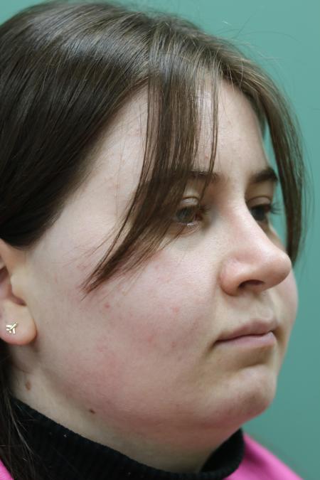After image 3 Case #122866 - Nasal Deviation Syndrome