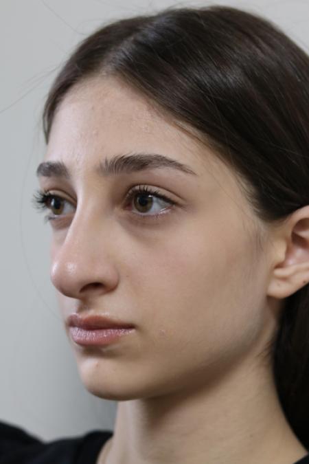 Before image 2 Case #122801 - Reduction Rhinoseptoplasty