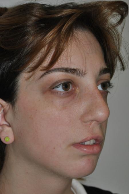 Before image 2 Case #123116 - Late Cleft Lip Nasal Deformity 
