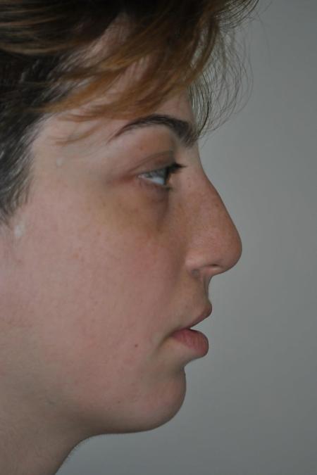 Before image 3 Case #122581 - Cleft-Lip Nose Secondary Reconstruction