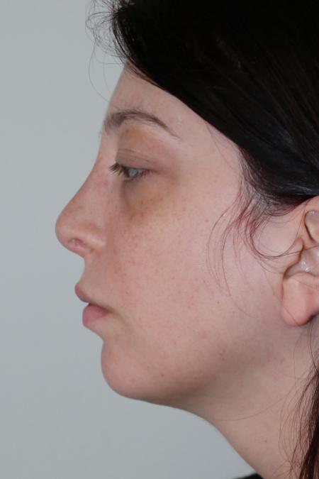 After image 4 Case #123116 - Late Cleft Lip Nasal Deformity 