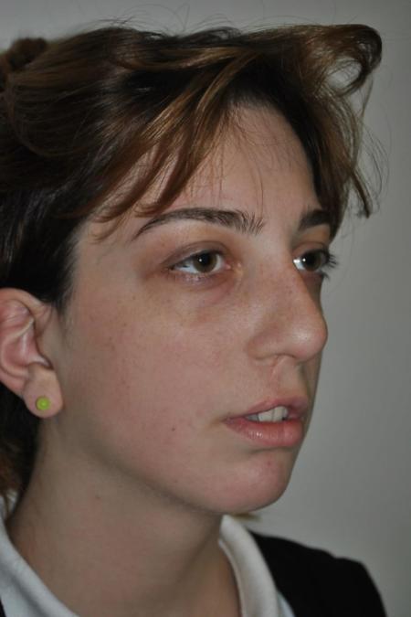 Before image 2 Case #122581 - Cleft-Lip Nose Secondary Reconstruction