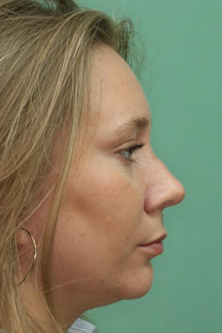 After image 4 Case #122876 - Nasal Deviation Syndrome. Rhinogenic Headache 