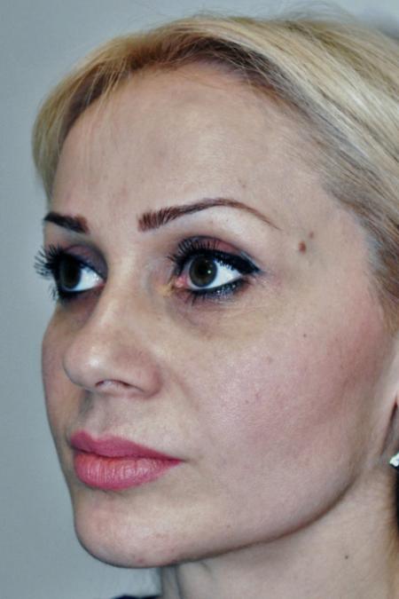 Before image 2 Case #122751 - Aesthetic Reduction Rhinoseptoplasty