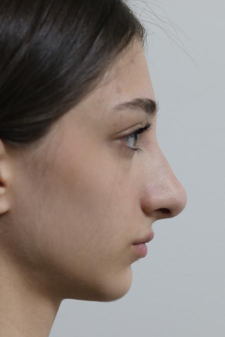 Before image 4 Case #122801 - Reduction Rhinoseptoplasty