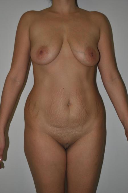 Before image 1 Case #122776 - Breast Autoaugmentation And Abdominoplasty