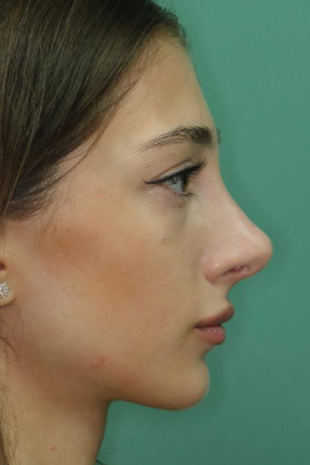 After image 4 Case #122801 - Reduction Rhinoseptoplasty