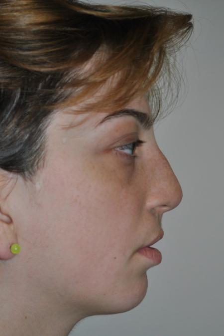 Before image 5 Case #123116 - Late Cleft Lip Nasal Deformity 