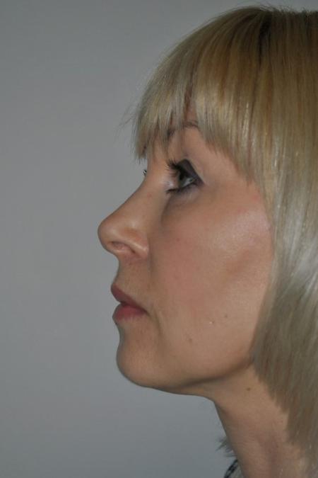 After image 5 Case #122606 - Fat Transfer