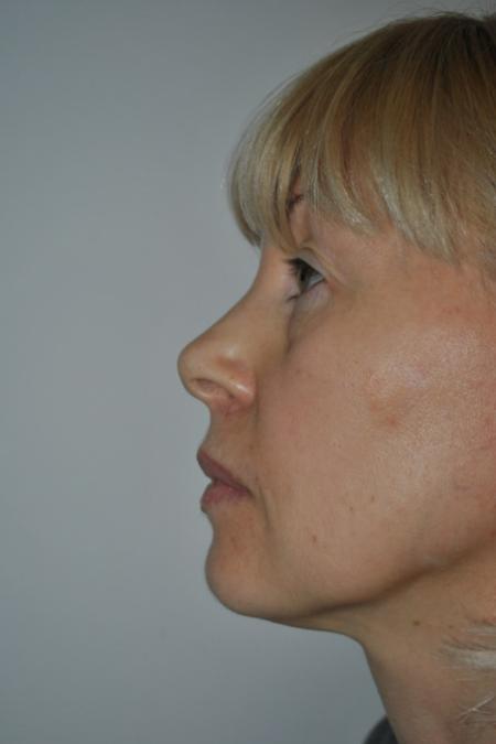 Before image 5 Case #122606 - Fat Transfer
