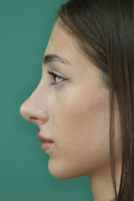 After image 5 Case #122801 - Reduction Rhinoseptoplasty