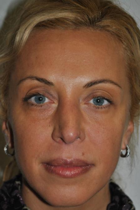 Before image 1 Case #122731 - Revision Rhinoplasty