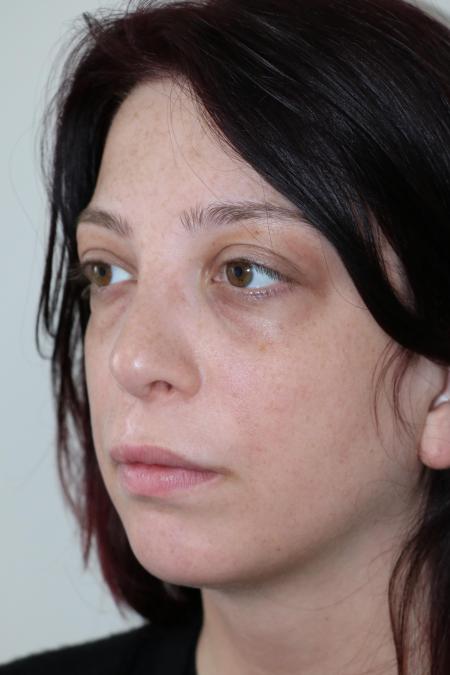 After image 3 Case #123116 - Late Cleft Lip Nasal Deformity 
