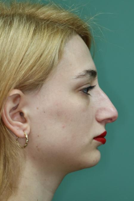 Before image 4 Case #122881 - Deviation Syndrome. Rhinogenic Headache 