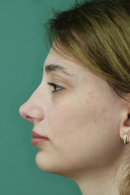 After image 5 Case #122881 - Deviation Syndrome. Rhinogenic Headache 