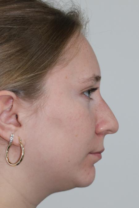 Before image 4 Case #122876 - Nasal Deviation Syndrome. Rhinogenic Headache 