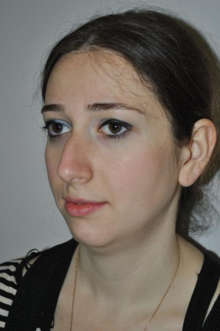 Before image 3 Case #122736 - Hybrid Rhinoplasty