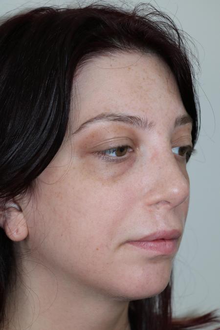 After image 2 Case #123116 - Late Cleft Lip Nasal Deformity 