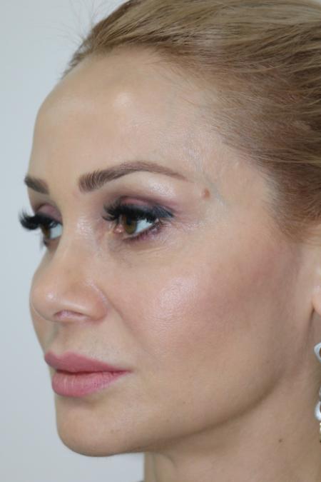 After image 2 Case #122751 - Aesthetic Reduction Rhinoseptoplasty