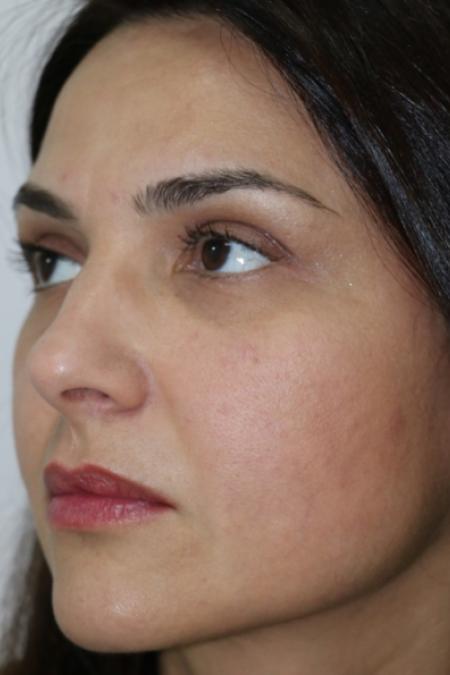 After image 2 Case #122756 - Fat Transfer