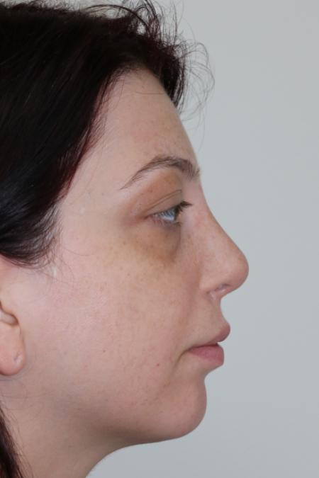 After image 5 Case #123116 - Late Cleft Lip Nasal Deformity 