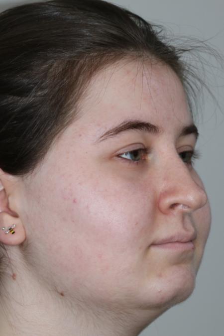 Before image 3 Case #122866 - Nasal Deviation Syndrome