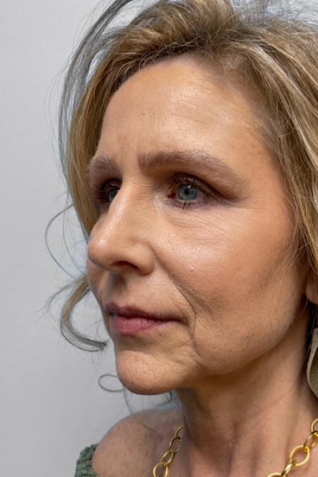 After image 2 Case #123466 - Rhinoplasty