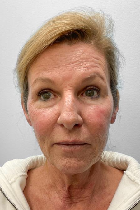 Before image 1 Case #123471 - Laser Resurfacing