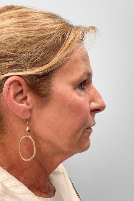 After image 3 Case #123471 - Laser Resurfacing