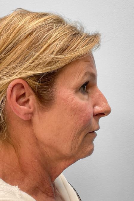Before image 3 Case #123471 - Laser Resurfacing