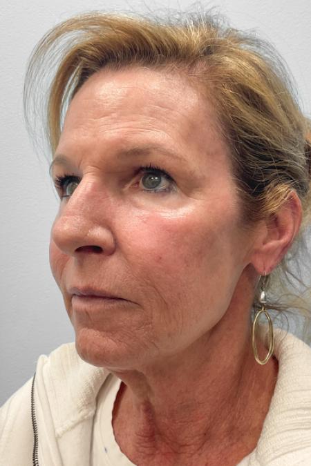 After image 2 Case #123471 - Laser Resurfacing