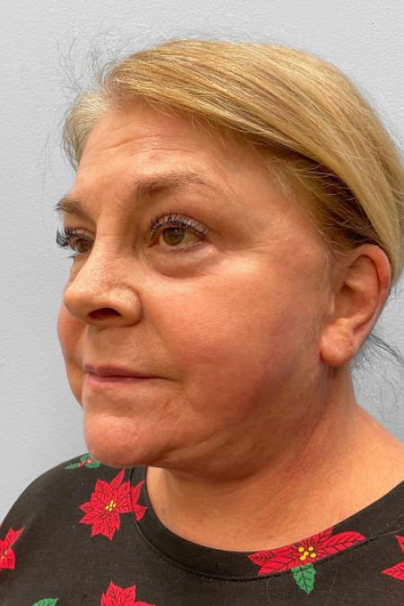 After image 2 Case #123521 - Facelift & Laser Resurfacing