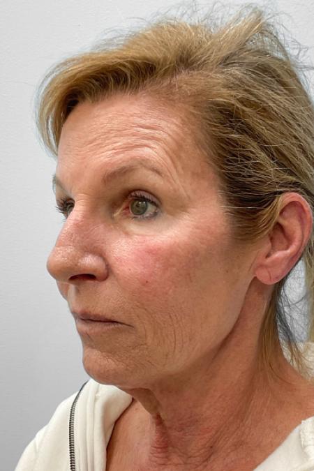 Before image 2 Case #123471 - Laser Resurfacing
