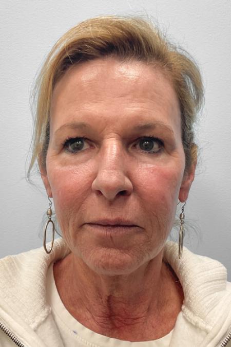 After image 1 Case #123471 - Laser Resurfacing