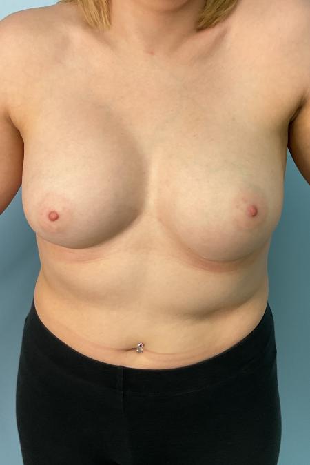 After Case #123431 - 32 year old female with Breast Augmentation