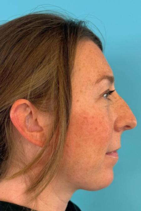 Before image 5 Case #125116 - New nose - breathing better and looking better :)