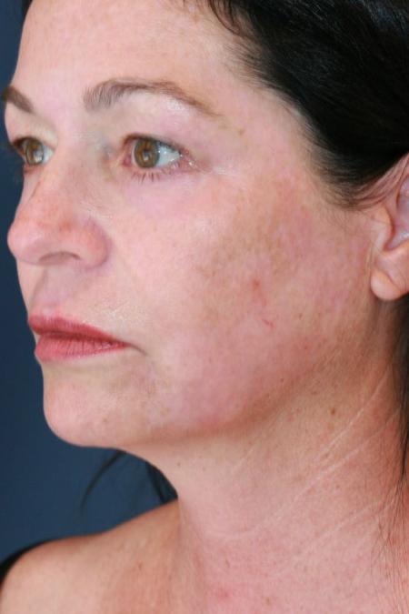After image 2 Case #125656 - Co2 Laser Resurfacing After image 2 Case #125656 - Co2 Laser Resurfacing