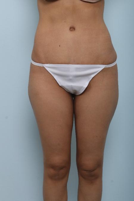After image 1 Case #125991 - Tummy Tuck