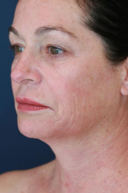 Before image 2 Case #125656 - Co2 Laser Resurfacing Before image 2 Case #125656 - Co2 Laser Resurfacing