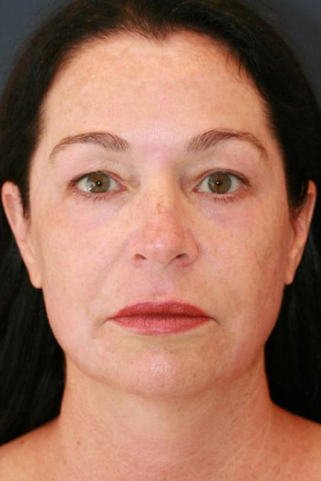 After image 1 Case #125656 - Co2 Laser Resurfacing