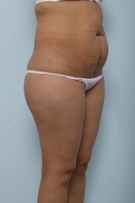 Before image 2 Case #125991 - Tummy Tuck
