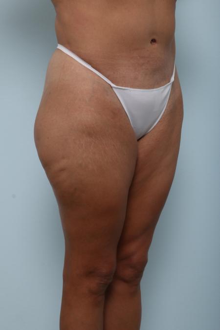 After image 2 Case #125976 - Body Lift