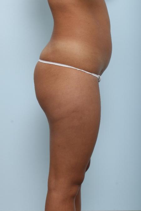 Before image 3 Case #125971 - Liposuction