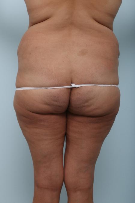 Before image 4 Case #125976 - Body Lift