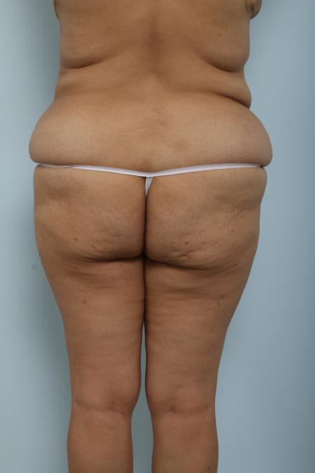 Before image 4 Case #125921 - Body Lift