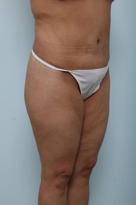 After image 2 Case #125921 - Body Lift